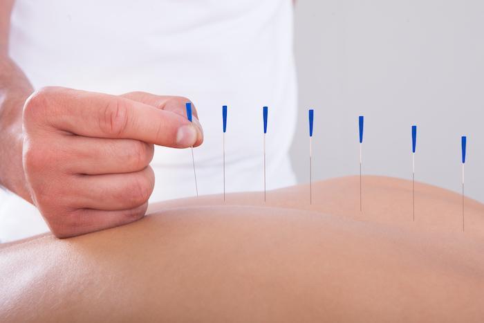 Medical acupuncture